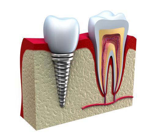 Display of dental implant in the mouth.