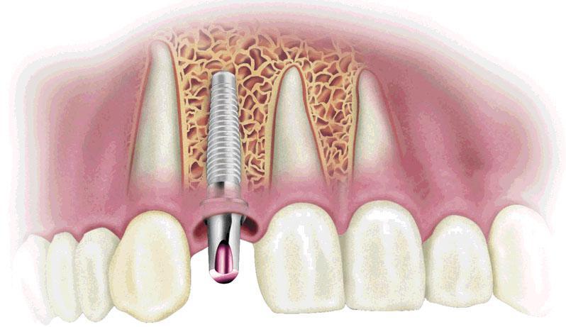 dental implants placed in the jawbone