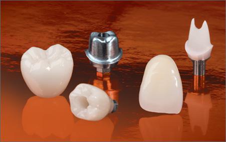 parts of a dental implant