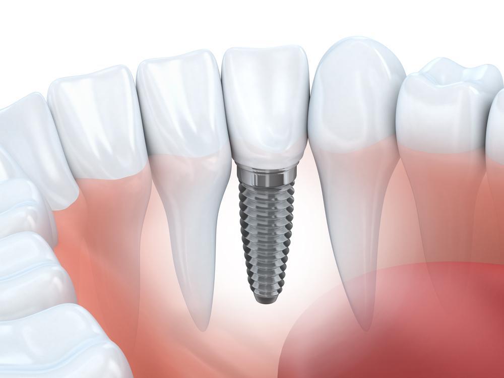 dental implant graphic