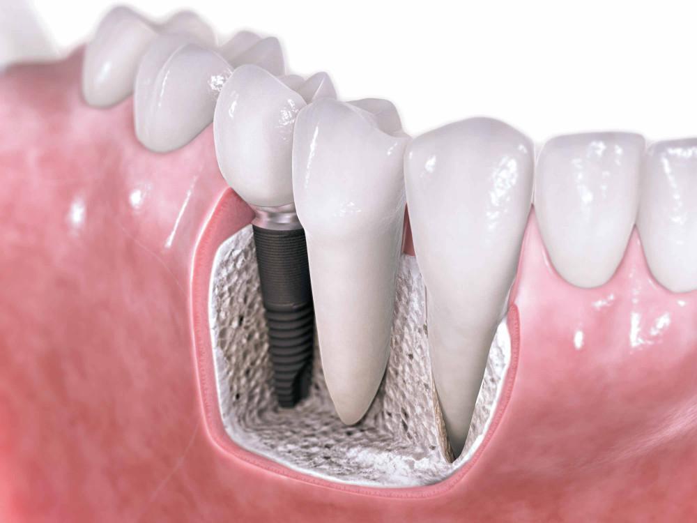 graphic of dental implants