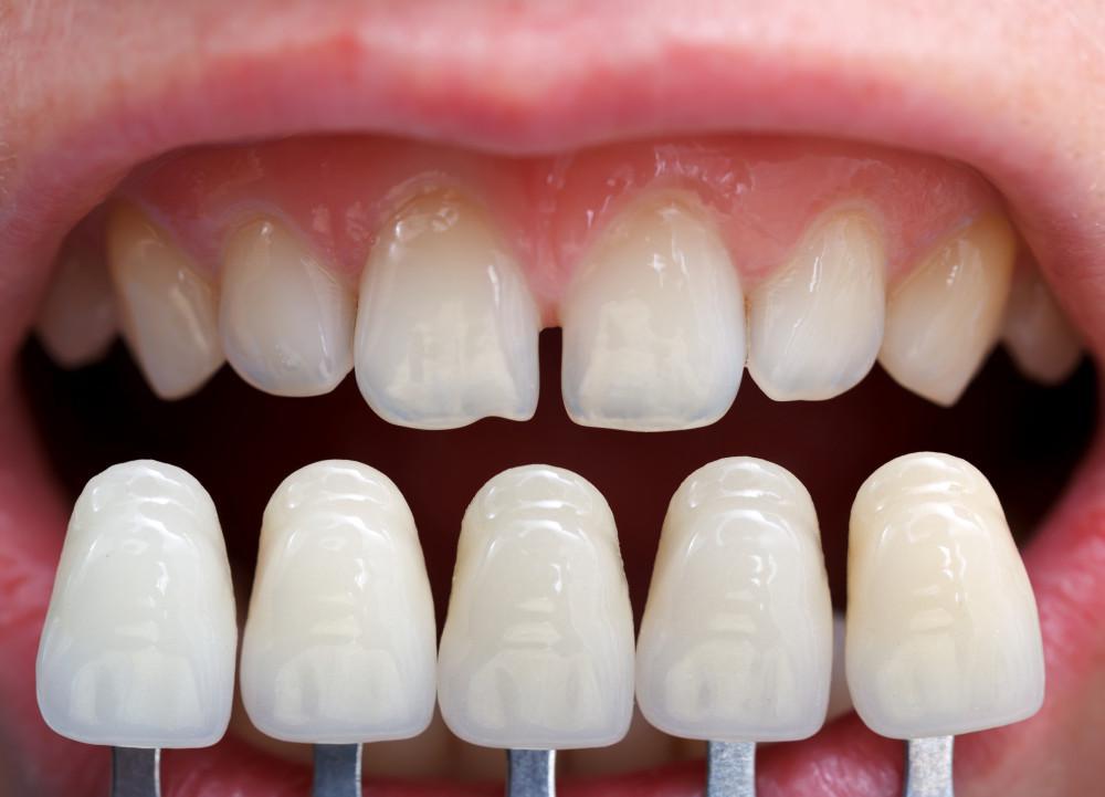 comparison of natural teeth and dental implants