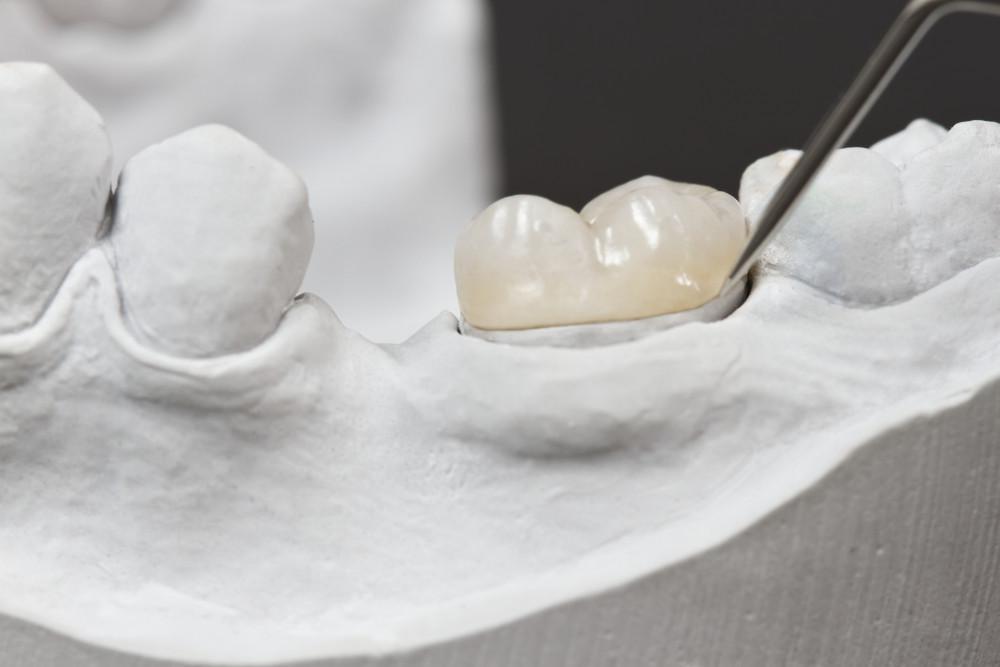 a mold of a patient's jaw.