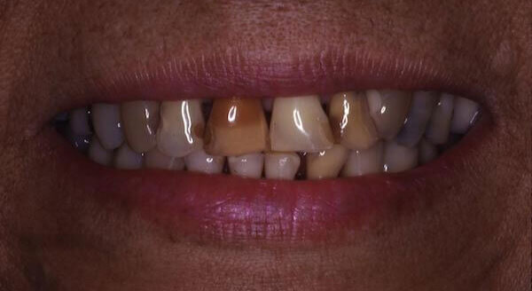 crooked and yellow teeth before treatment