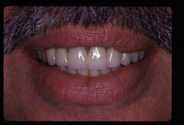 teeth after treatment