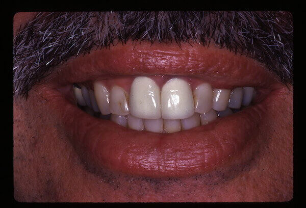 teeth before treatment