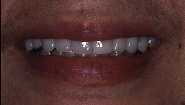 teeth after treatment