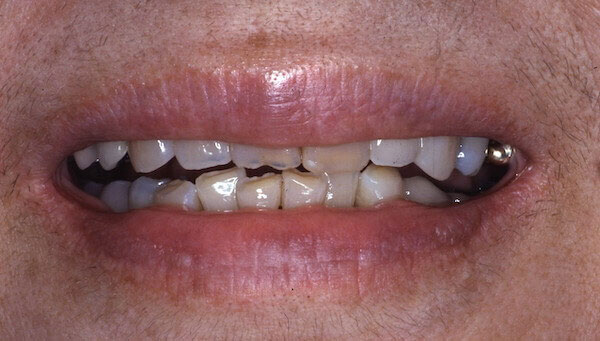 crooked teeth before dental treatment