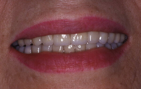 straight teeth after treatment