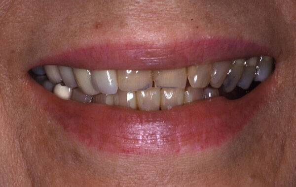 crooked, yellow teeth before treatment