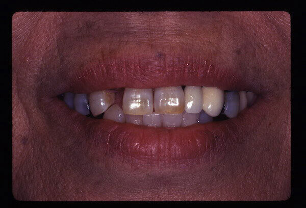 teeth before treatment