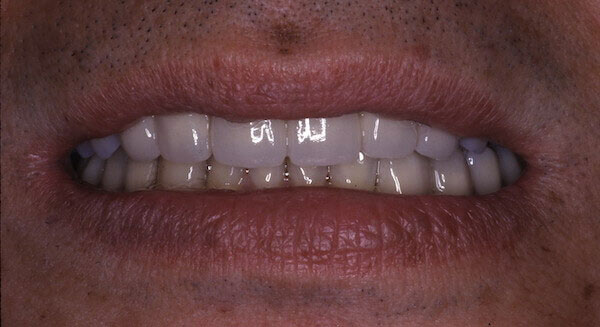 white teeth after treatment