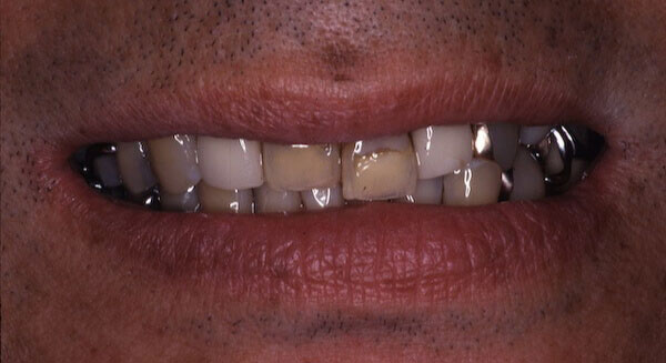 yellow, uneven teeth before treatment