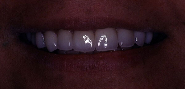 white teeth after dental treatment