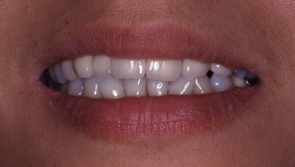 teeth before treatment