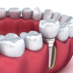 3D diagram of dental implant