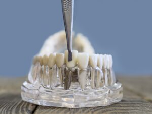 endosteal dental implant